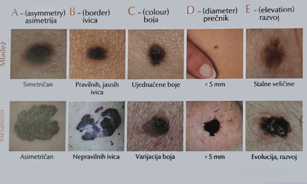 Melanom – najređi, a najopasniji oblik raka kože