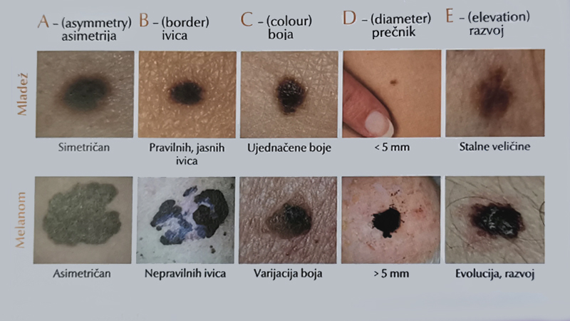 Melanom – najređi, a najopasniji oblik raka kože